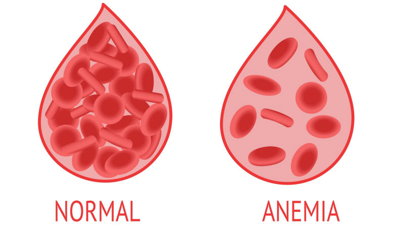 Anemia, Gejala Lemas yang Sering Diabaikan – PAFI Kota Arga Makmur
